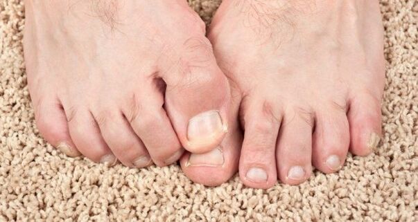 Nagu sēnītes simptomi