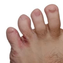 sēne starp pirkstiem