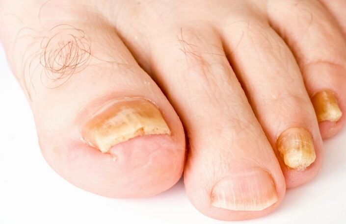 Sēne uz kājas īkšķa