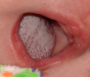 Slimības lokalizācija ar sēnīti