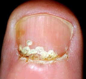 Slimības simptomi un pazīmes