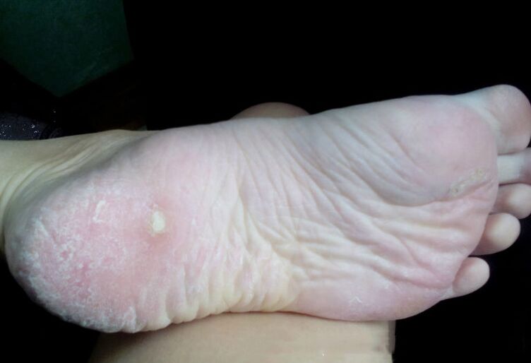 Sēnītes ārstēšana ar lāzeru