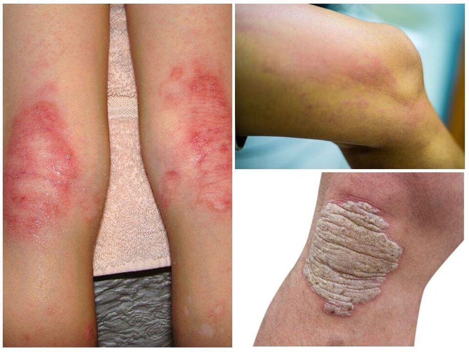 Ceļu sēnīšu infekcijas