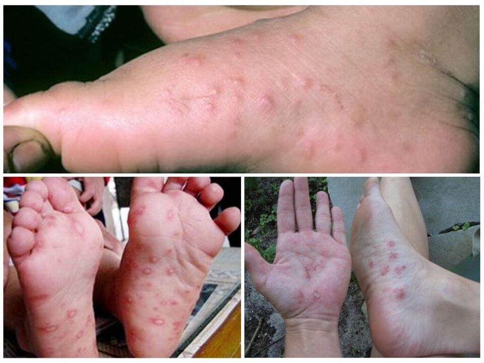 Hiperkeratotiski pēdu bojājumi