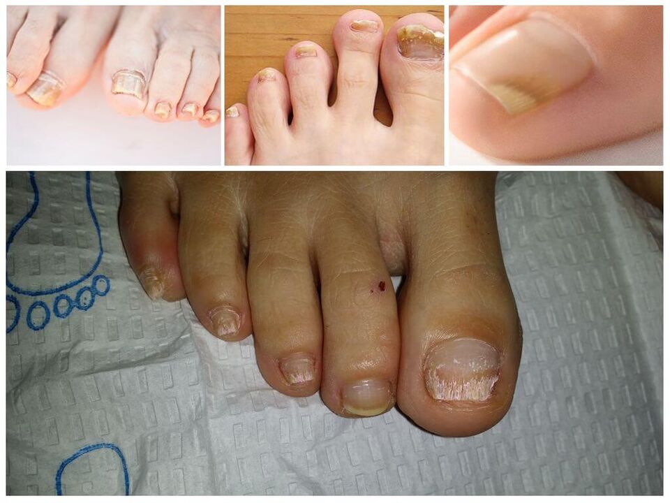 Nagu plākšņu sēnīšu slimības