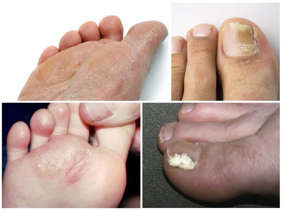 Pēdu sēnītes sākuma stadija