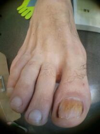 lielā pirksta nagu sēnīte