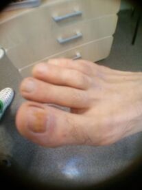 īkšķa nagu sēnītes sākuma stadija