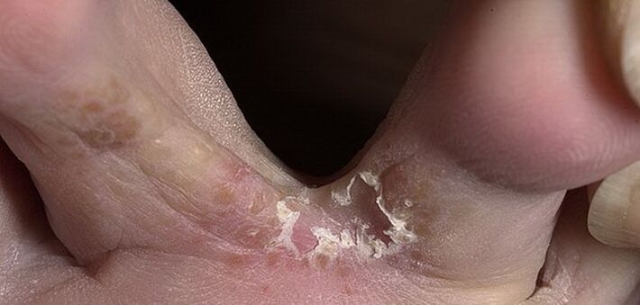 sēnīte starp kāju pirkstiem