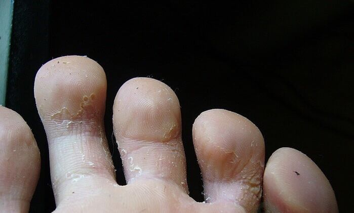 sēnītes sākuma stadija