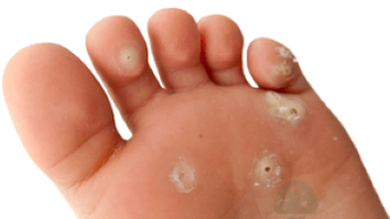 sēnīšu infekcijas otrais posms