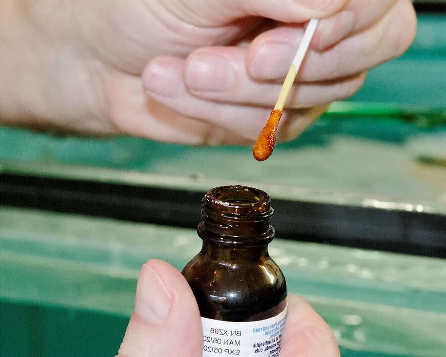 Uzklājot kāju nagus ar joda un struteņu sulas maisījumu, atbrīvosies no sēnītes